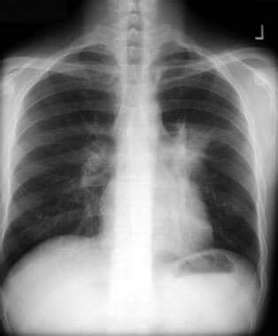 Pulmonary Blastomycosis Imaging: Practice Essentials, Radiography, Computed Tomography