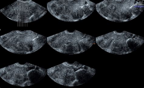 Tomographic ultrasound imaging or multi-view showing different cross ...