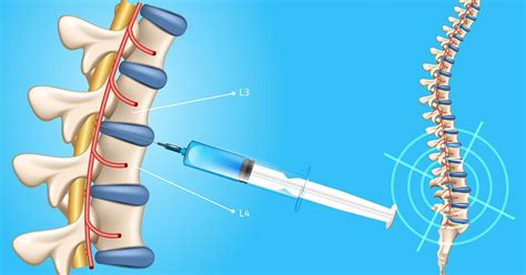 Lumbar Puncture - Atlanta, GA - Spine Surgery