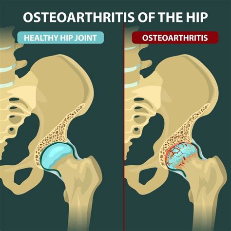 Hip Arthritis Hip Pain Explained Osteoarthritis In Hips Rheumatoid | Sexiz Pix