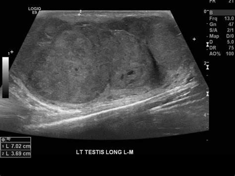 Testicular Seminoma Ultrasound