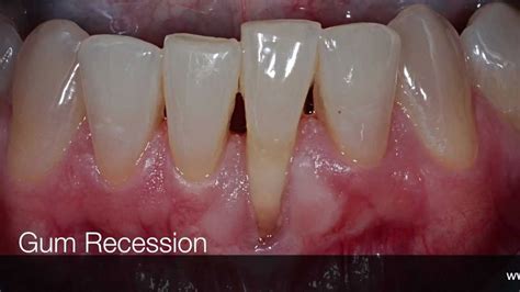 Gum Recession Surgical Treatment - YouTube