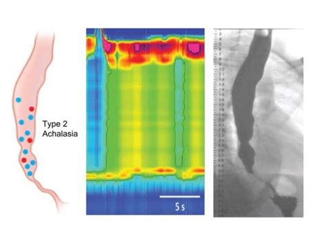 Achalasia of the oesophagus - London Gastroenterology Centre