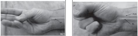 Schaeffer's test; the tendon of palmaris longus (PL) on the right hand ...