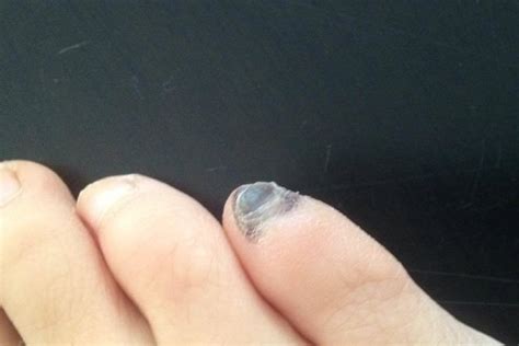 How To Treat Black Toenails | Blister Prevention