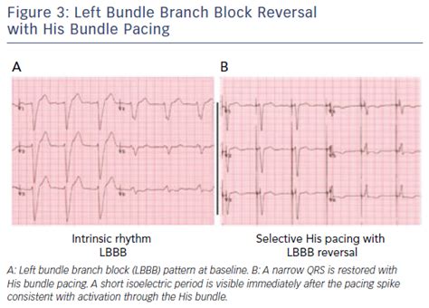 Left Bundle Branch Block Vs Right Bundle