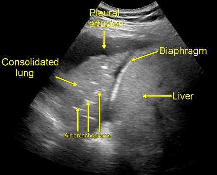 Air bronchogram | Radiology Reference Article | Radiopaedia.org