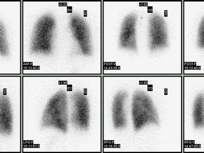 Lung ventilation/perfusion scan | Diagnosis & Treatment | Britannica