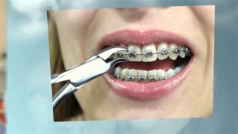 Get That Picture-Perfect Smile With Braces Available In Aurora - YouTube