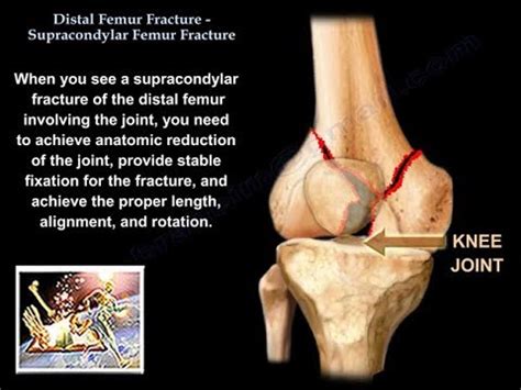 Distal Femur Supracondylar Fracture - Everything You Need To Know - Dr ...