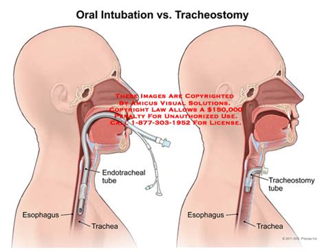 Oral Intubation vs. Tracheostomy