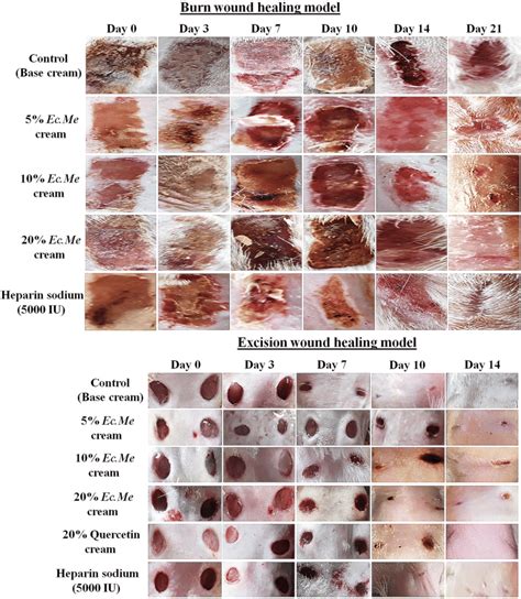 Phases Of Burn Healing