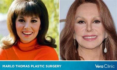 Marlo Thomas Plastic Surgery: Separating Fact from Fiction