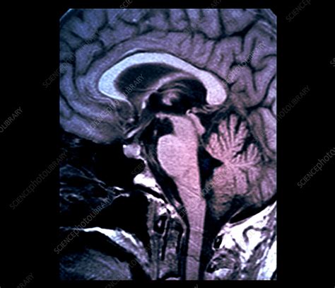 Healthy midbrain, MRI scan - Stock Image - C055/1635 - Science Photo Library