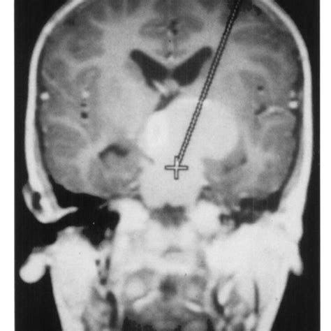 (PDF) Stereotactic Insertion of an Ommaya Reservoir: Technical Note