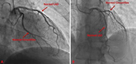 Cureus | Vasospastic Angina and Role of Cardiac Catheterization