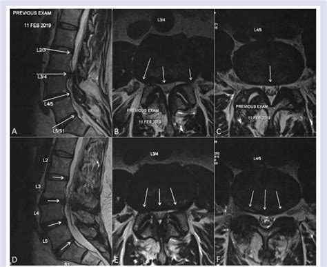 A 67-year-old male presented with low back pain and lumbar... | Download Scientific Diagram