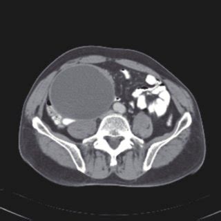 Abdominal computerized tomography scan with contrast. | Download Scientific Diagram