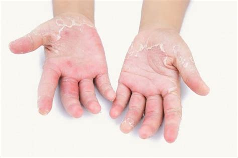 Treating Palmar/Plantar Psoriasis | The Dermatology Center Of Indiana