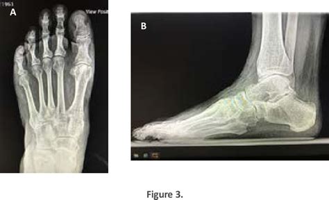 Figure 3 from Treatment of Pes Planovalgus Deformity following Failed Arthrodesis in a Patient ...