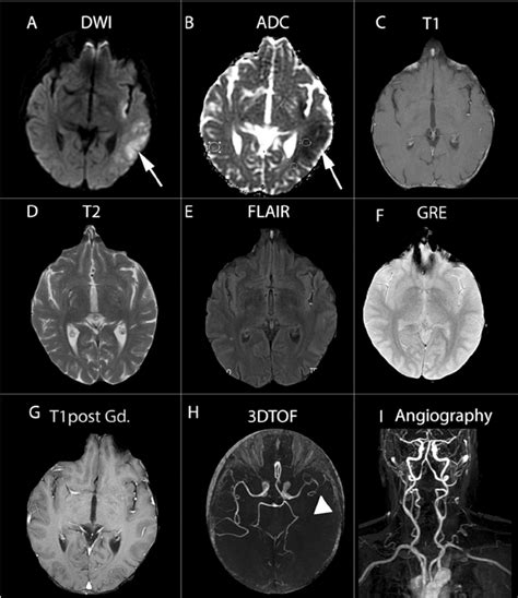 Comprehensive MRI assessment in acute stroke using DWI, PWI and MR ...