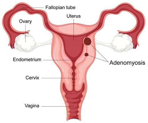 Adenomyosis – stages, symptoms and treatment | healthdirect