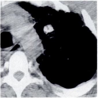 -Mycetoma. A, CT scan reveals eccentric calcification in a nodule. B ...