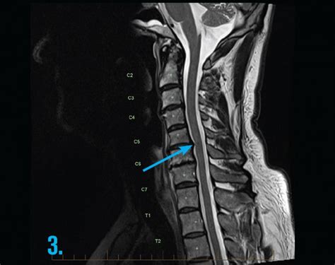 mri-cervical-spine-radiculopathy-gp-series - MRI at Melbourne Radiology Clinic