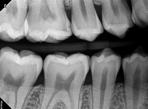 What Does a Cavity Look Like on an X-Ray? - Web DMD