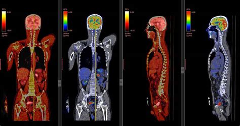 What Is A PET Scan And What Is It Used For? - Health365.sg