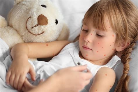 Dr. Brownstein: Chickenpox Vaccine Risk Too High – Vaccine Should Never Have Occurred - Vaccine ...