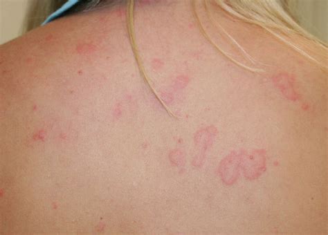 Hives: 10 Symptoms of Hives