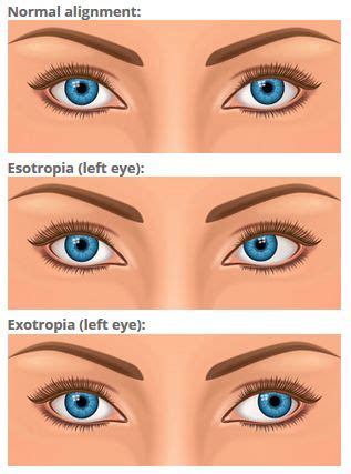 Strabismus (Crossed Eyes) - All About Vision