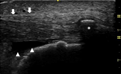 Long axis ultrasound image of Achilles tendon insertion with... | Download Scientific Diagram