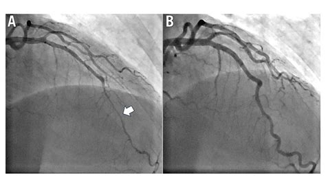 Coronary spasm and vasomotor dysfunction as a cause of MINOCA ...