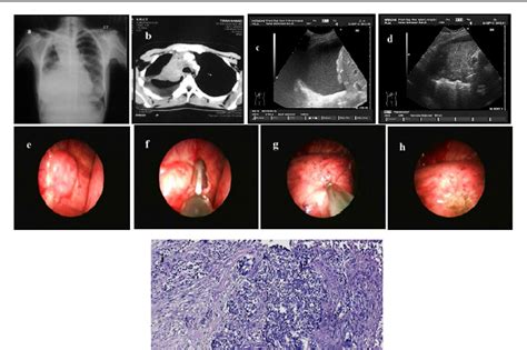 Figure 1 from Ultrasound guided closed pleural biopsy versus medical thoracoscopic pleural ...