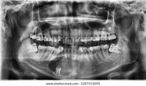 1 Calcifying Odontogenic Cyst Royalty-Free Photos and Stock Images | Shutterstock