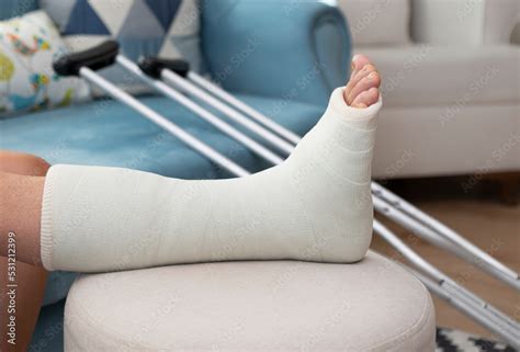 broken ankle and a leg cast. Leg splint Stock Photo | Adobe Stock