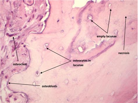 Bisphosphonate-related osteonecrosis of jaw (BRONJ): diagnostic criteria and possible pathogenic ...