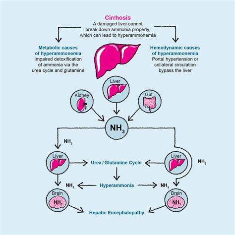 Causes and pathogenesis of hepatic encephalopathy – Hepa-Merz ...