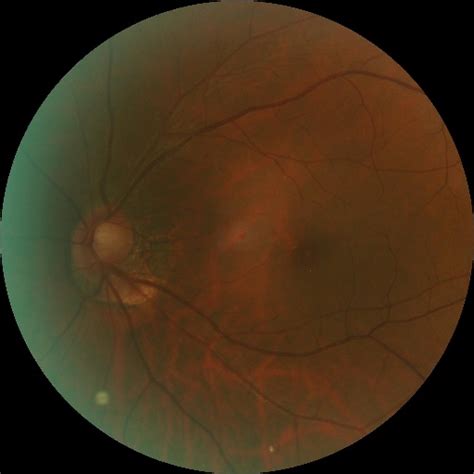 eye diseases Classification Dataset by indian servers