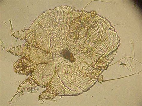 Scabies Bites: How to Identify Scabies