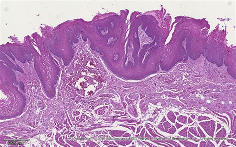 Low magnification image of the tongue illustrating the fungiform papillae with non-keratinised ...