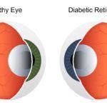 Diabetic Retinopathy Treatment at NeoVision in Union City