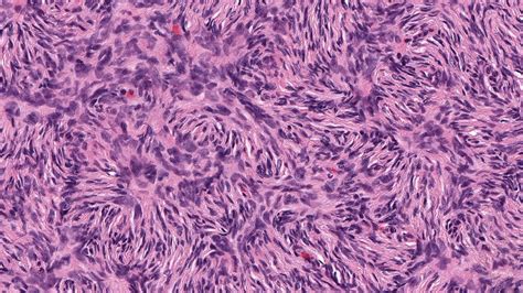 Dermatofibrosarcoma Protuberans Histology