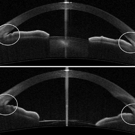 A Anterior segment OCT of an angle closure glaucoma with narrow angles... | Download Scientific ...