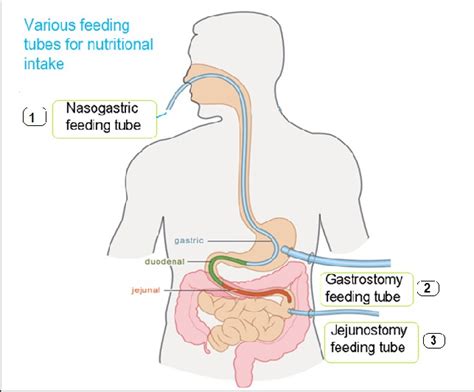 A Smart Companion for People on Tube Feeding Regimens - Medrecord