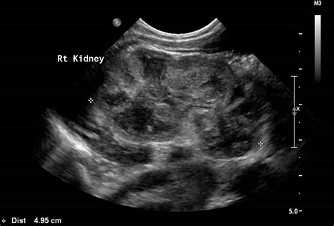 Kidney Ultrasound