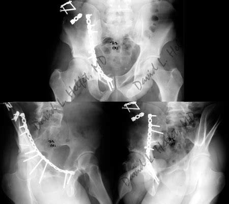 Acetabular Fractures - Orthopedic Trauma Service