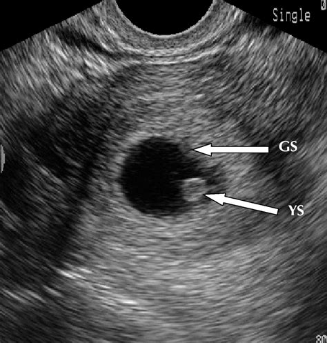 Ectopic Pregnancy Ultrasound Vs Normal Pregnancy